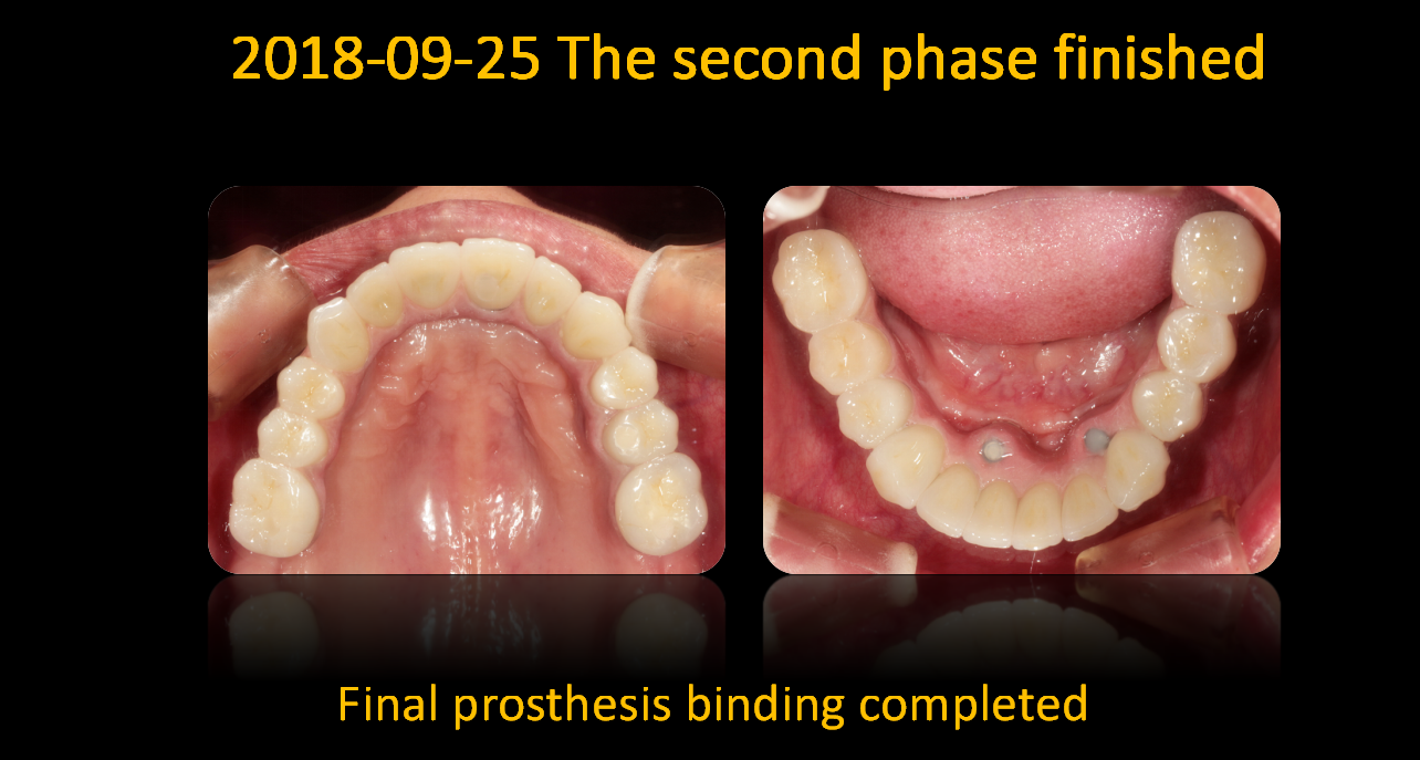 Final prosthesis binding completed_2