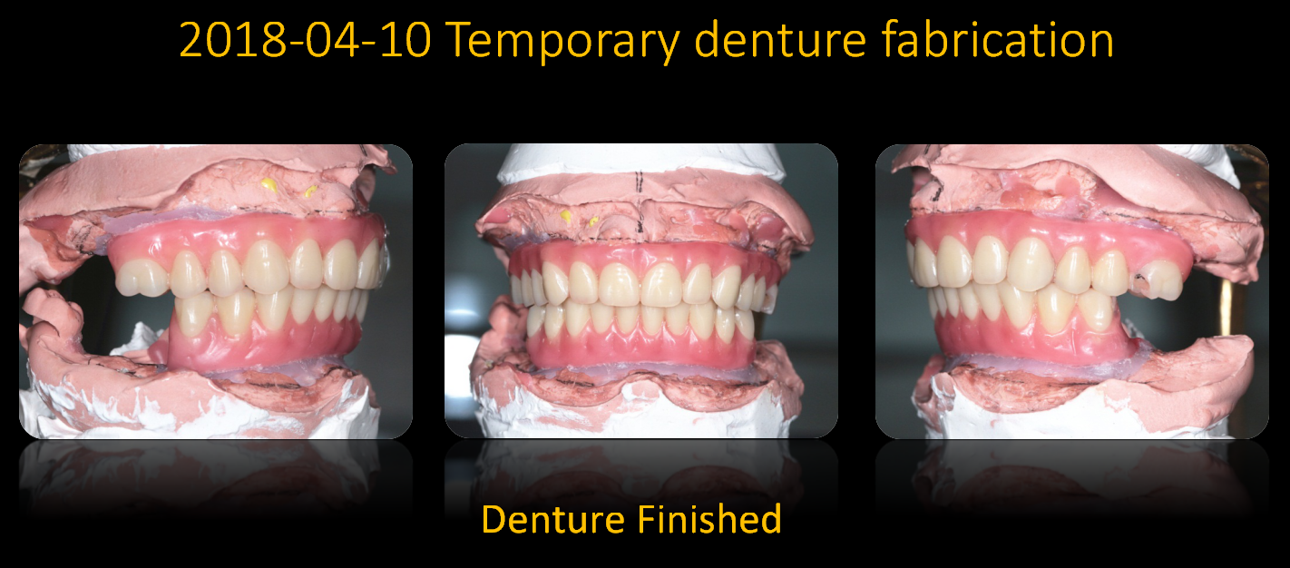 Temporary_denture_fabrication