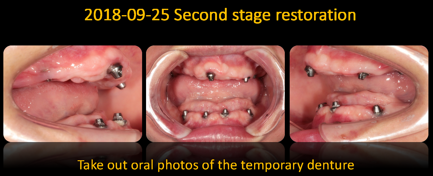 Take_out_oral_photos_of_the_temporary_denture
