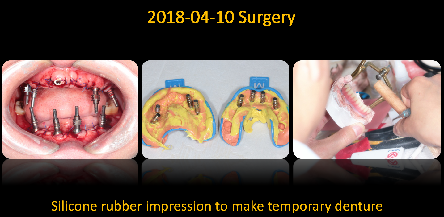 make_temporary_denture