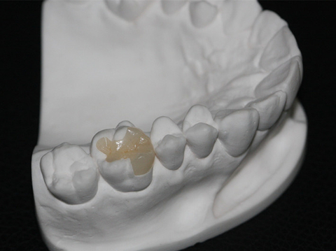 IPS E.max Veneer/Crown