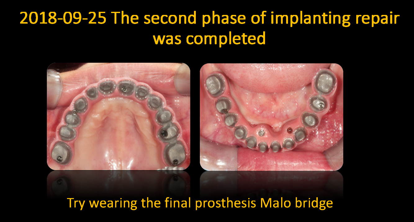 Try_wearing_the_final_prosthesis_Malo_bridge