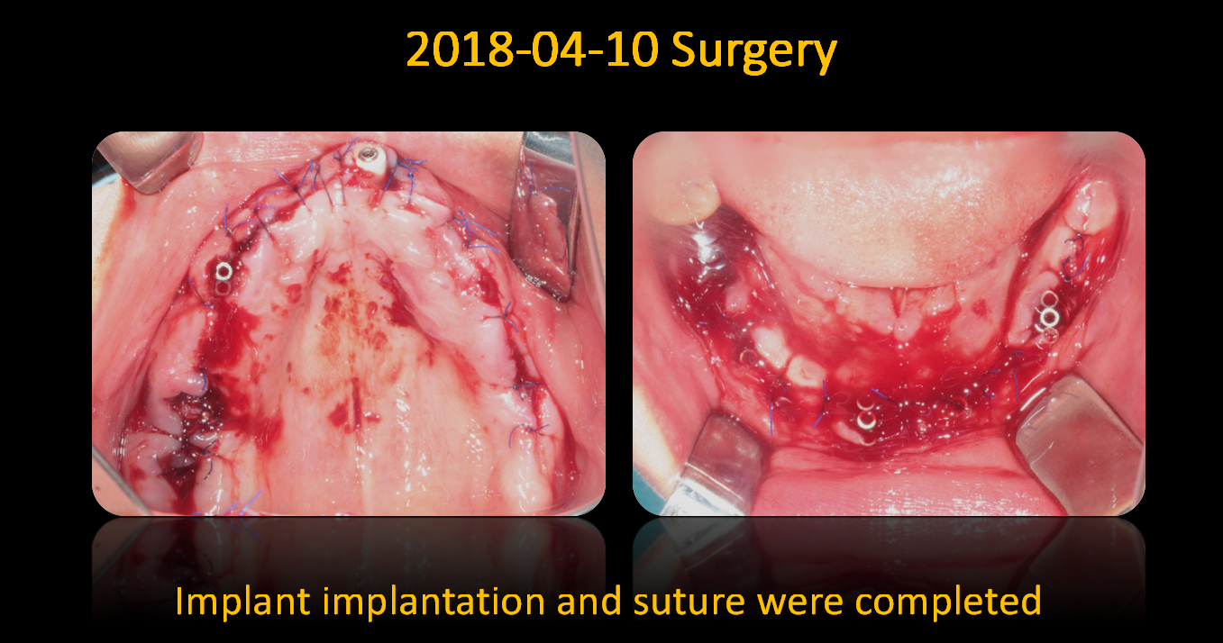 Implant_implantation_and_suture_were_completed
