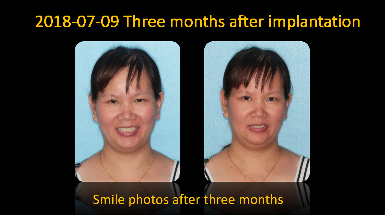 smile_photos_after_3_months
