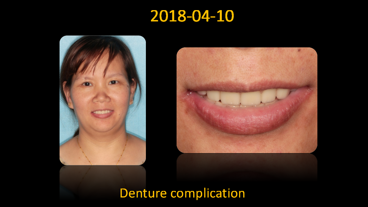 Denture_complication