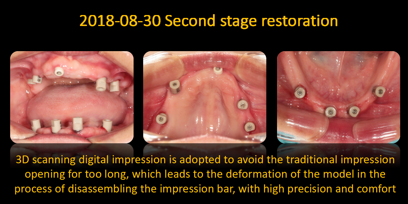 Screw-Retained Implant