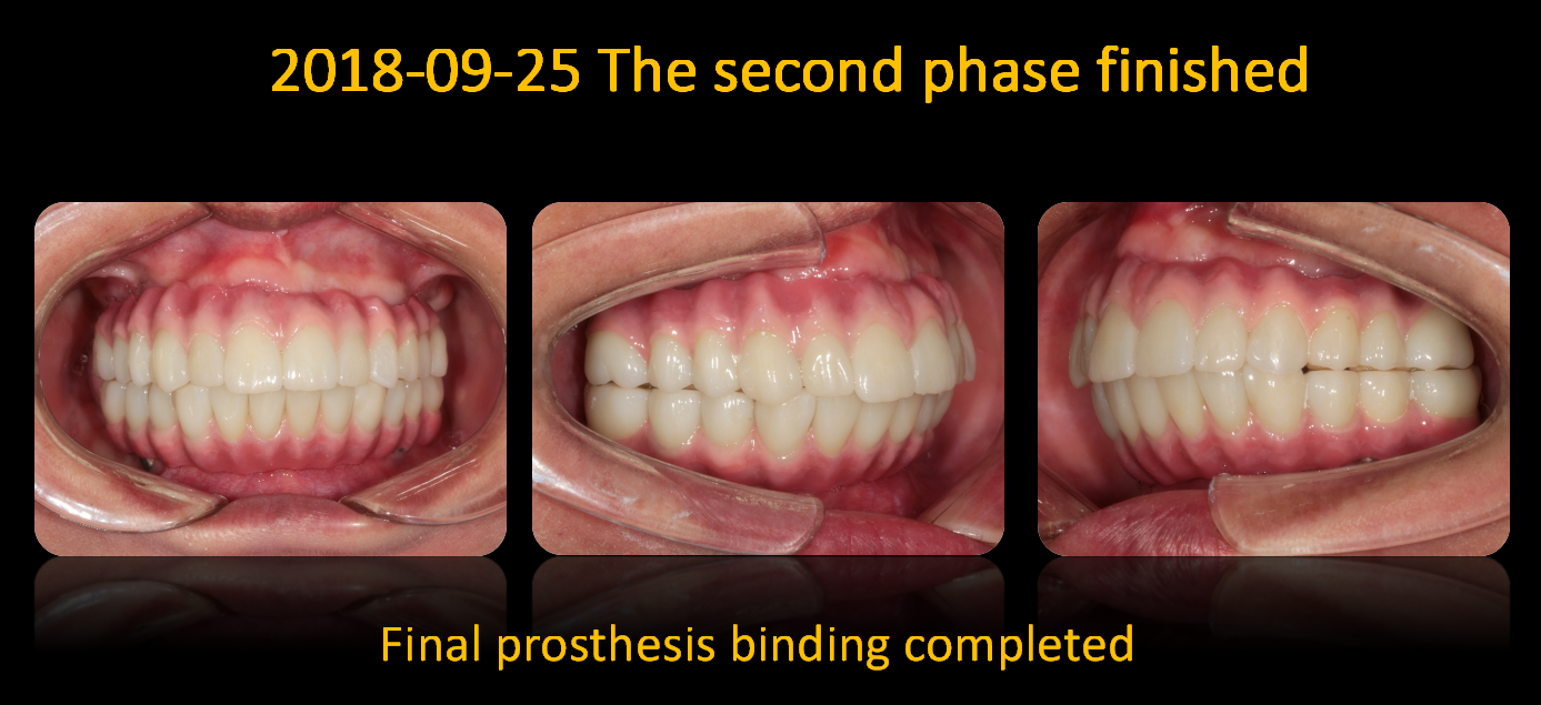 Final_prosthesis_binding_completed