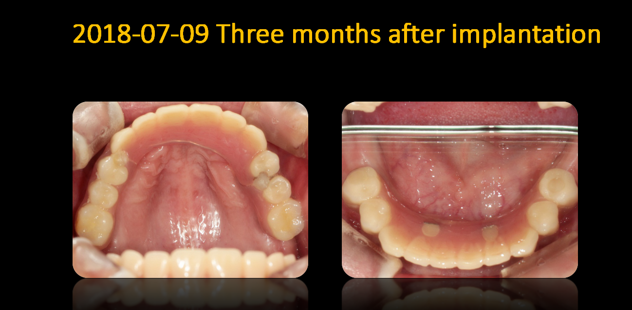 Photos_in_mouth_after_3_months_2