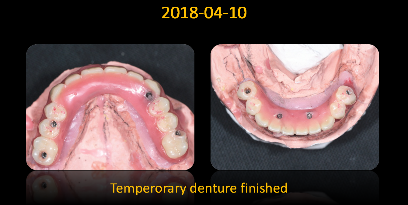Overdenture