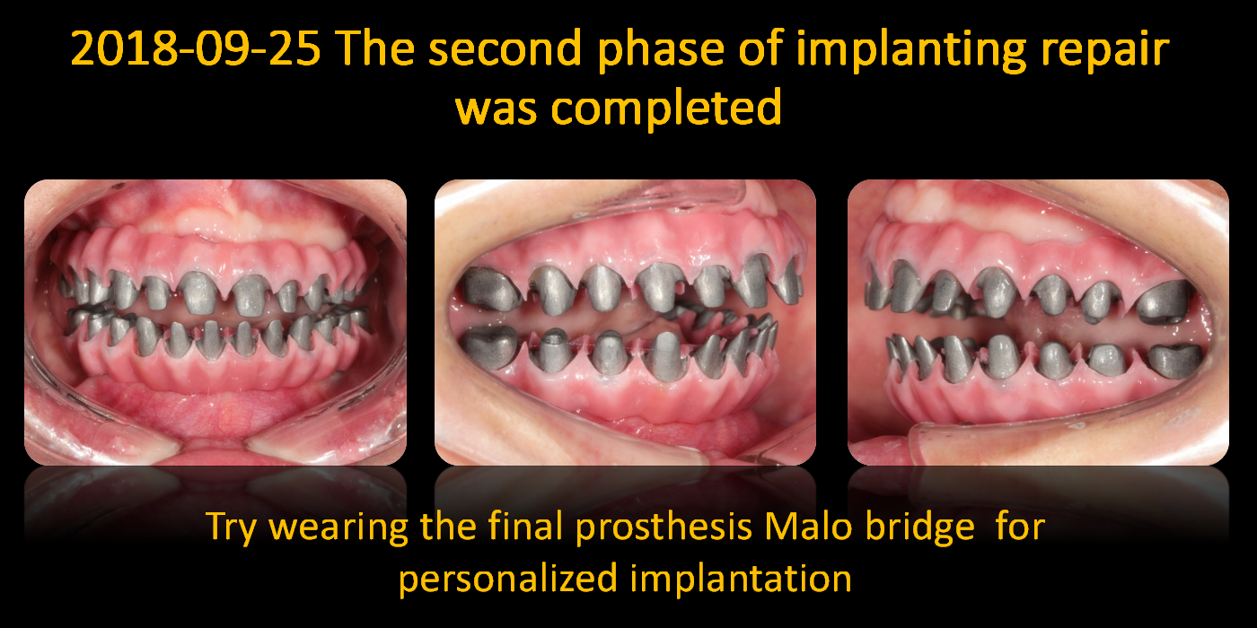 Try_wearing_the_final_prosthesis_Malo_bridge_for_personalized_implantation
