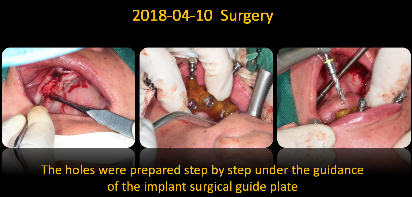 The_holes_were_prepared_step_by_step_under_the_guidance_of_the_implant_surgical_guide_plate