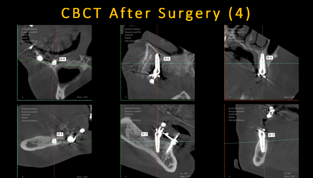 CBCT_After_Surgery_(4)