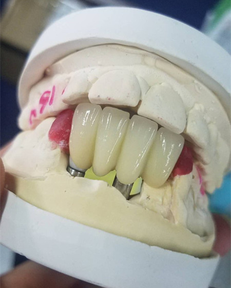 dental_implant_case