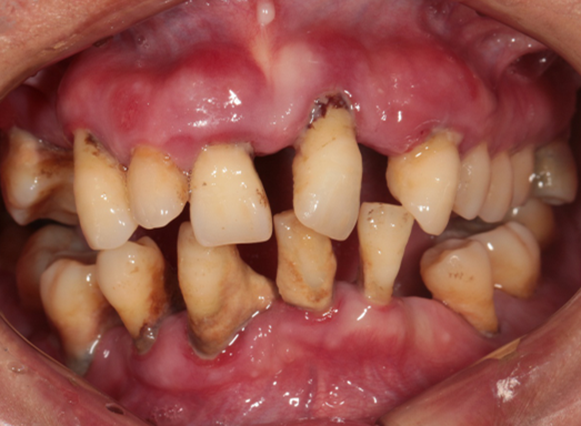 Basic_information_of_patients_CDL