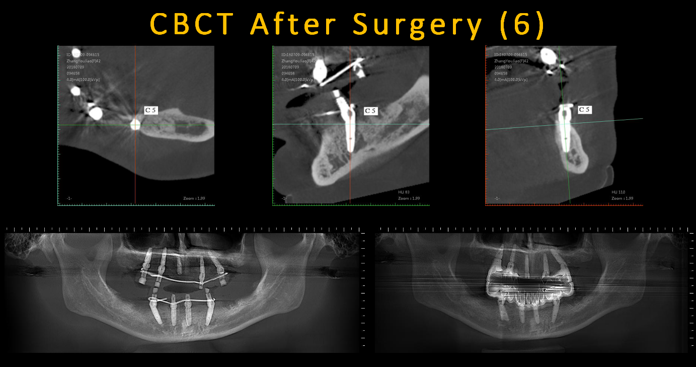 CBCT_After_Surgery_(6)