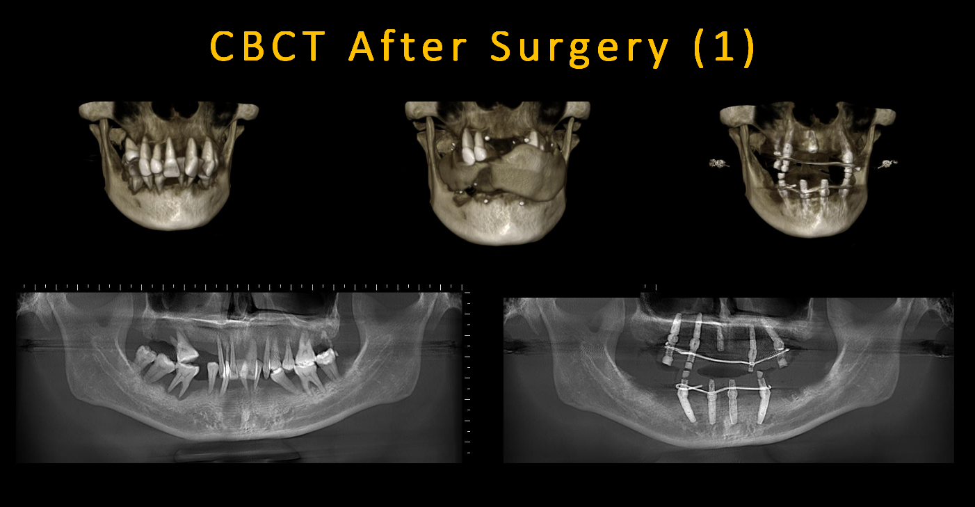 CBCT_After_Surgery_(1)
