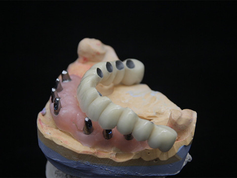 Cemented Implant Crown/bridge