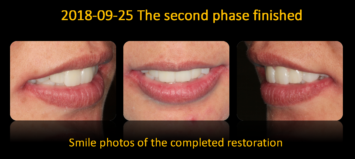 Smile_photos_of_the_completed_restoration