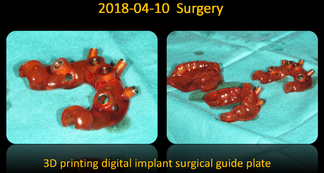 3D_printing_digital_implant_surgical_guide_plate