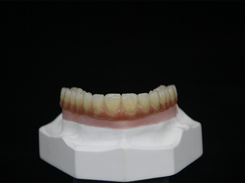 Screw-retained Implant