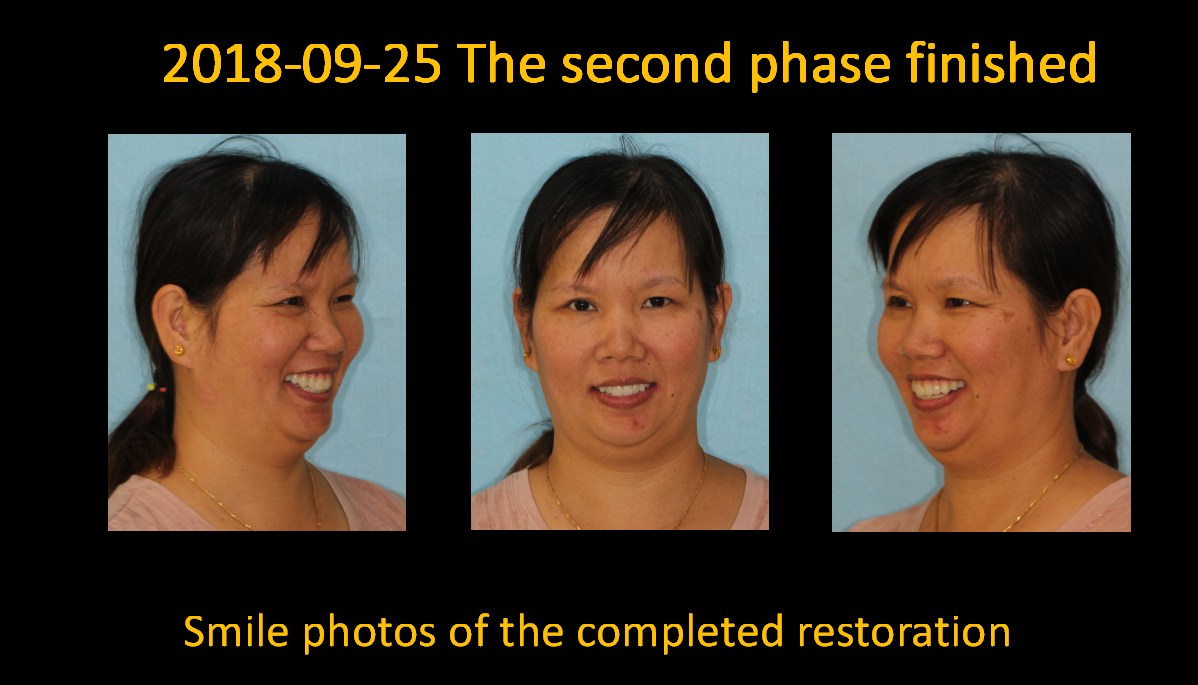 Smile_photos_of_the_completed_restoration_1