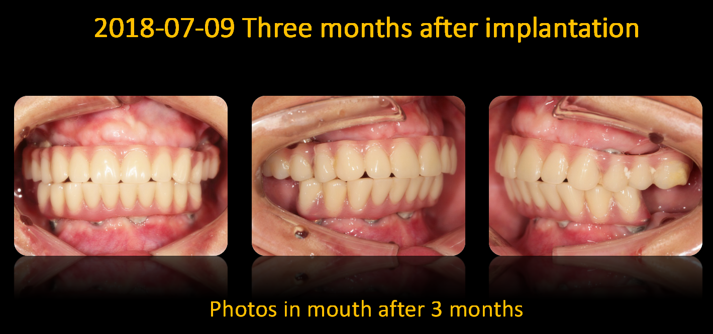 Photos_in_mouth_after_3_months_1