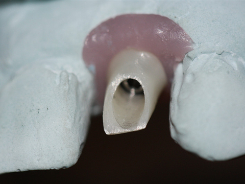 Custom Abutment