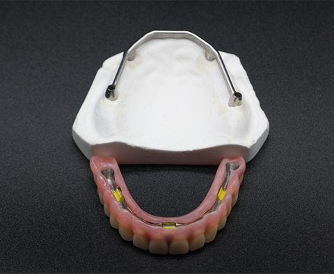 Implant Bar