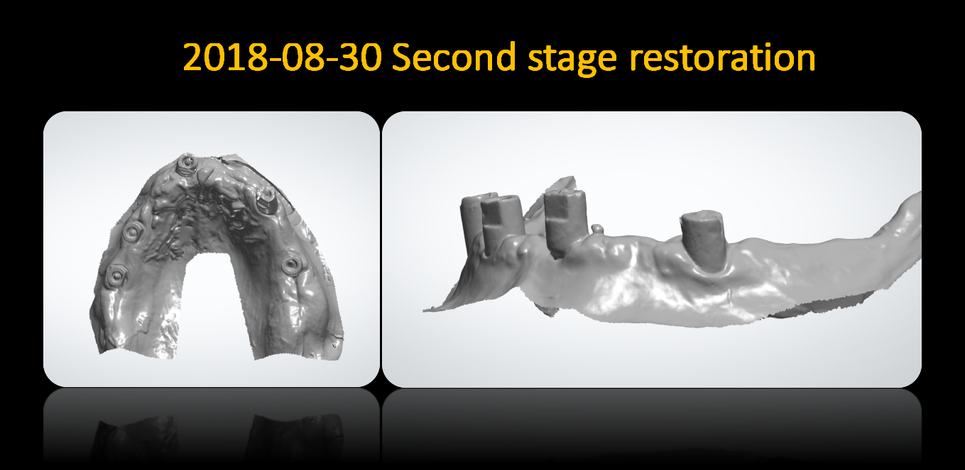 Second_stage_restoration