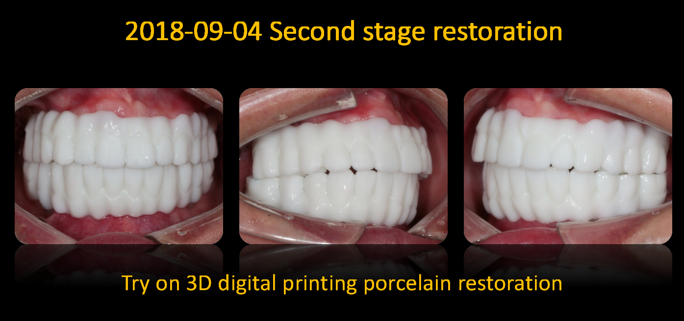 Try_on_3D_digital_printing_porcelain_restoration
