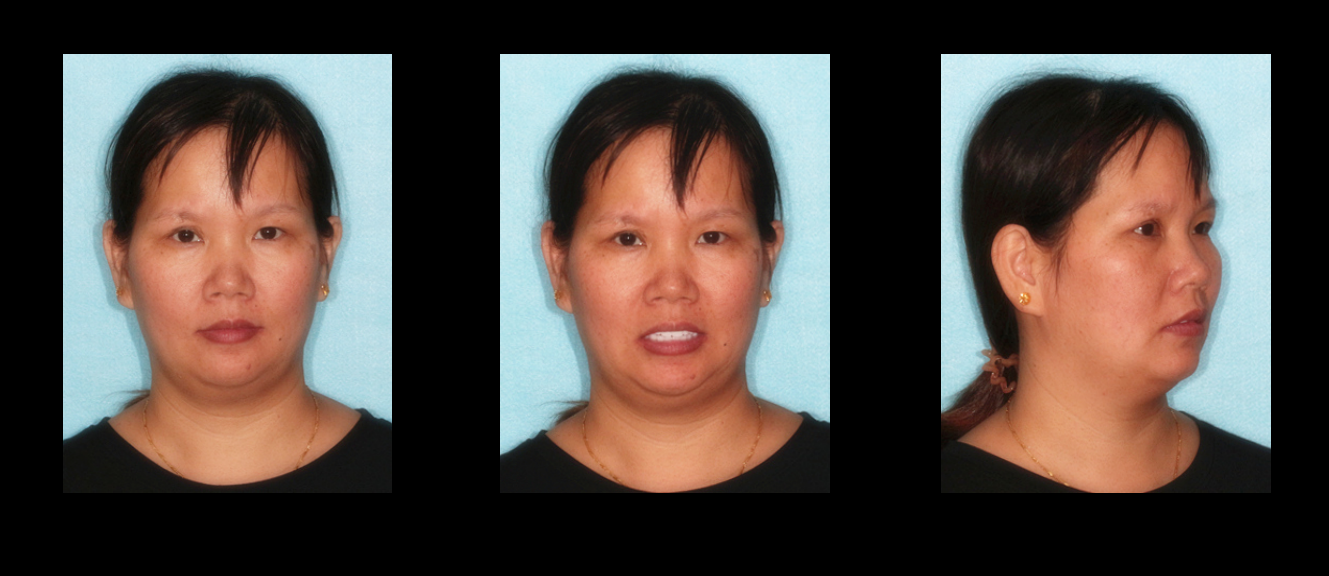 Patient's_photos_of_second_stage_restoration