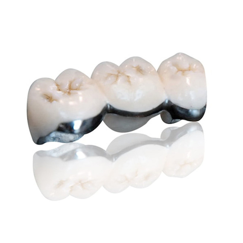 Porcelain-Fused-to-Metal (PFM) Crowns
