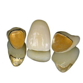 Porcelain-Fused-to-Metal (PFM) Crowns