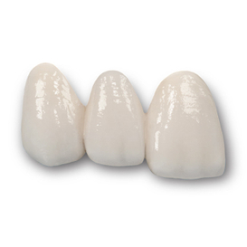 IPS E.max Veneer/Crown
